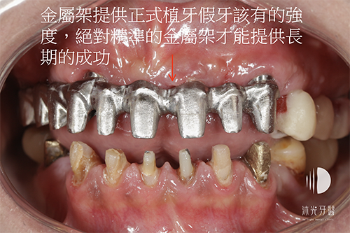 全口重建（pib）4